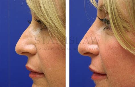 Liquid Rhinoplasty Gallery 4 Before And After Photos Connecticut