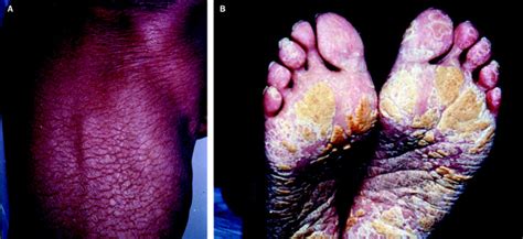 Acquired Icthyosis A Paraneoplastic Skin Manifestation Of Hodgkins Disease The Lancet Oncology