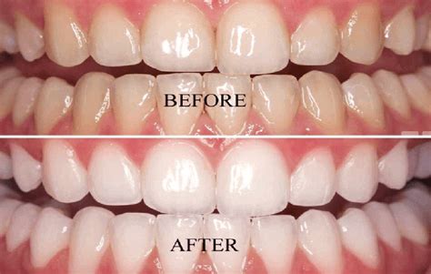 Tooth Discolourations And Bleachingwhitening