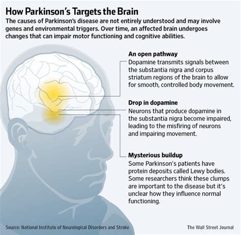 Parkinsons Disease Drug Side Effects Have New Possible Treatments Wsj