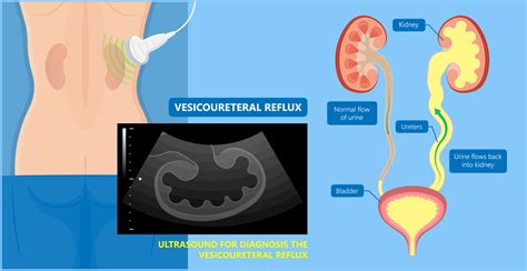 vesicoureteral reflux causes symptoms and treatment