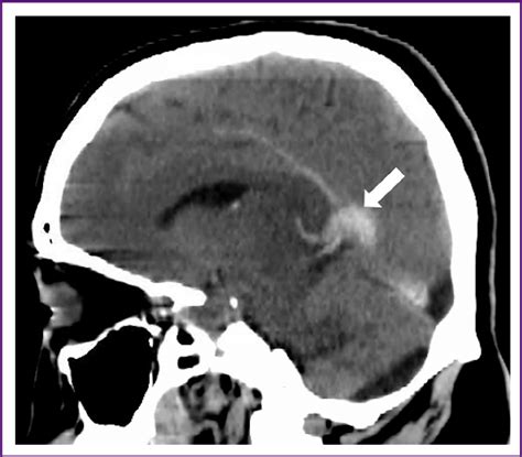 Sagittal Noncontrast Head Computed Tomography Scan Showing Cerebral