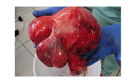 Myomlar her dört kadından birinde görülür. Uterus-Myome - gesundheit.com