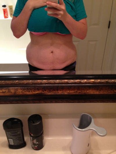 A tummy tuck procedure can be used to restore the look of a flat and contoured midsection tummy tuck procedures have been shown to carry more complication risks than other cosmetic procedures. Would an Extended Tummy Tuck and No Lipo Give Me Good ...