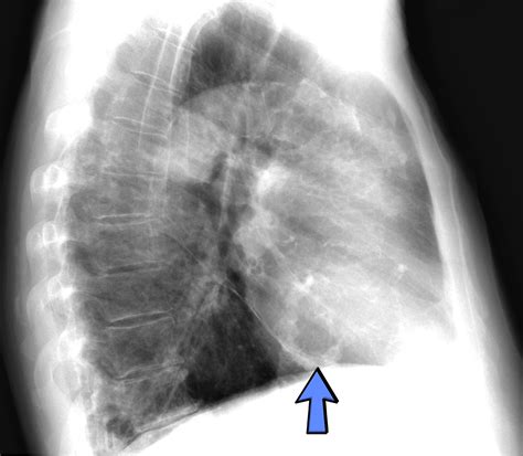 Mitral Annular Calcification