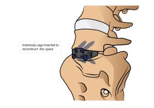 Minimal Invasive Anterior Lumbar Interbody Fusion ALIF Dr Yu Chao Lee