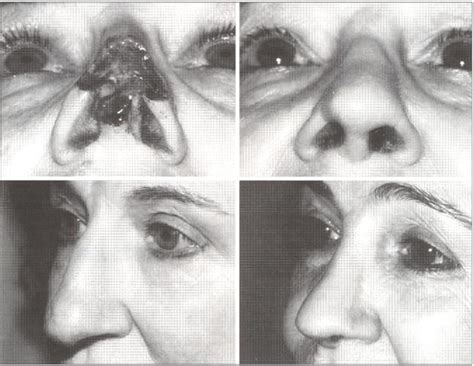 Esthetic Refinements In Forehead Flap Nasal Reconstruction