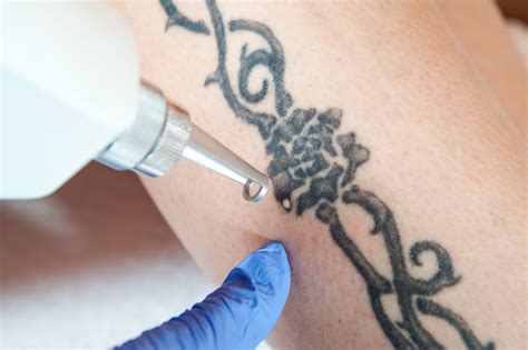 Complete and total healing of the rest of the tattoo beneath the skin will take around six months. How Long Does It Take to Remove a Tattoo? - Better Off