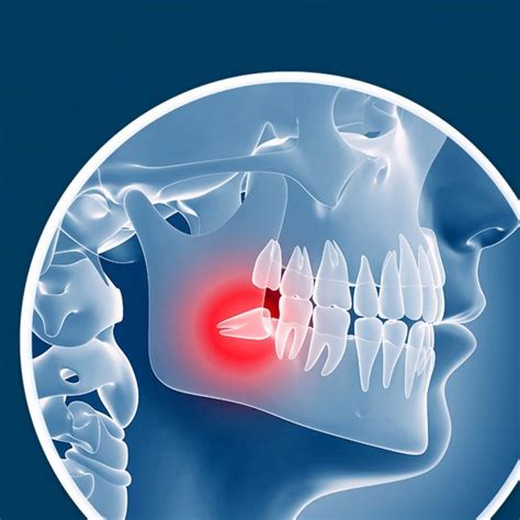 Does Everyone Have To Get Their Wisdom Teeth Out Boston Dentist
