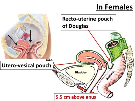 The pouch of douglas is the lowest area of the peritoneal cavity in women. Peritoneum Dr. Mehul Tandel