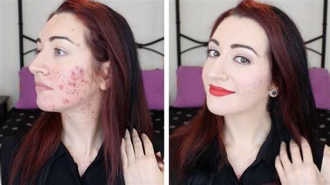 How I Cover Acne Scarring And Redness Makeup Transformation And Chit