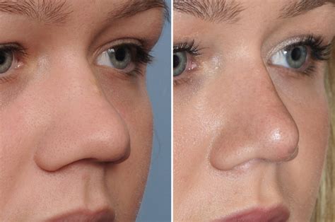 Plastic Surgery Case Study Narrowing In The Wide Nose Rhinoplasty