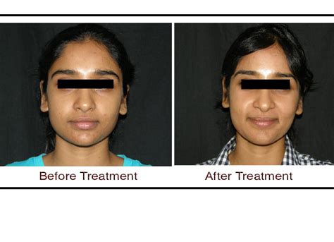 Skin Lightening Treatment In Hyderabad