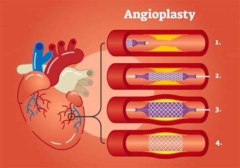 All You Need To Know About Angiography And Angioplasty Divine Heart