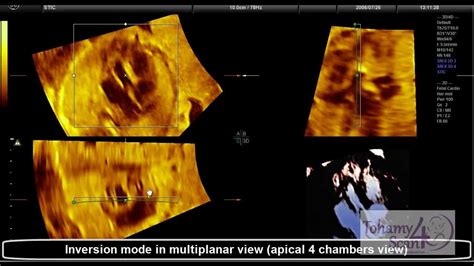 Fetal Echocardiography Is 4d Ultrasound Helpful Introduction To
