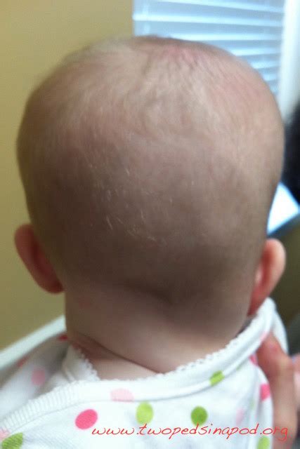 Why Is My Babys Head Flat About Plagiocephaly Two Peds In A Pod®