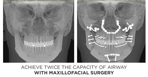 How Corrective Jaw Surgery Can Double The Size Of Your Airway Airway