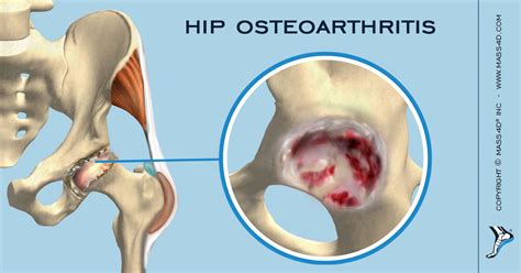 Understanding Hip Osteoarthritis Mass4d Foot Orthotics
