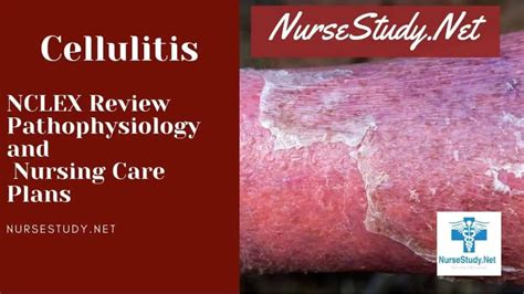 Cellulitis Nursing Care Plans And Diagnosis Interventions Nursestudynet