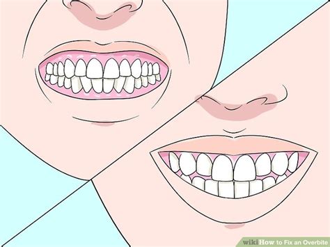 But the reality is…that's not really what it is. How to Fix an Overbite: 9 Steps (with Pictures) - wikiHow