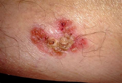 Squamous Cell Carcinoma Picture Image On