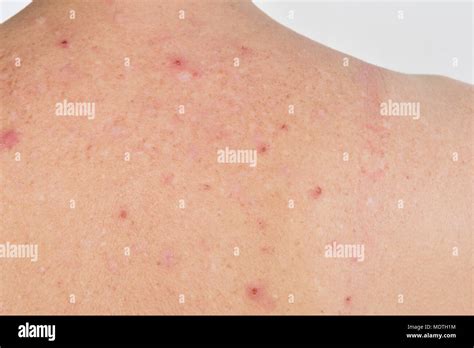 Dermatitis On The Back Of A Woman Stock Photo Alamy