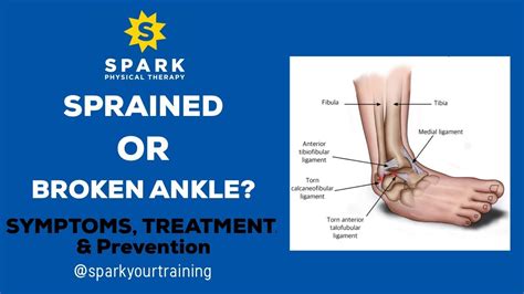 Sprained Or Broken Ankle Symptoms Treatment And Prevention Youtube