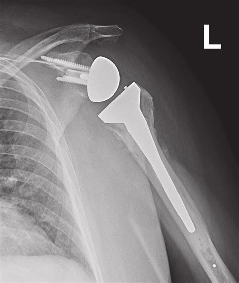 Displaced Proximal Humerus Fracture