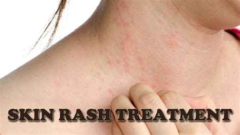 Medicine For Itchy Skin Rash Medicinewalls