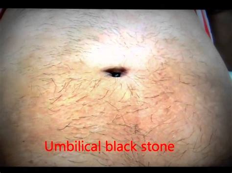 Clean Your Navel Belly Umbilicus Properly Or You May Face This In Your Belly Button Youtube