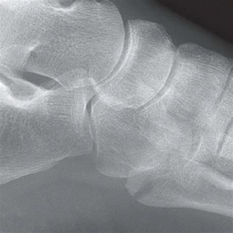 Base Of Fifth Metatarsal Fracture Radiology Key