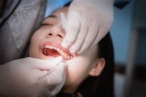 What Exactly Is A Wisdom Tooth Silicon Valley Dental Associates