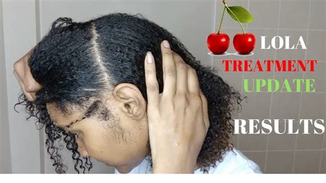 Cherry Lola Treatment Before And After Does It Really Work Youtube