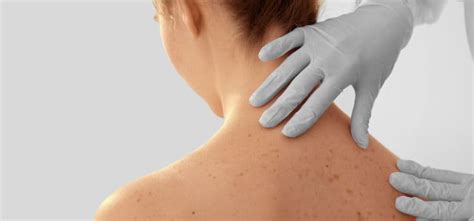 Skin Cancer Screening In Boca Raton Fl Dermpartners