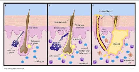 Table 2 From Hidradenitis Suppurativa Disease Burden And Etiology In