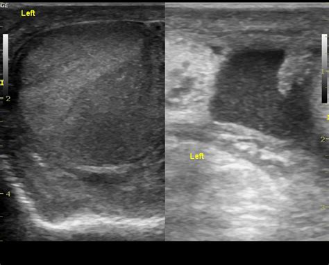 Isolated Orchitis Image