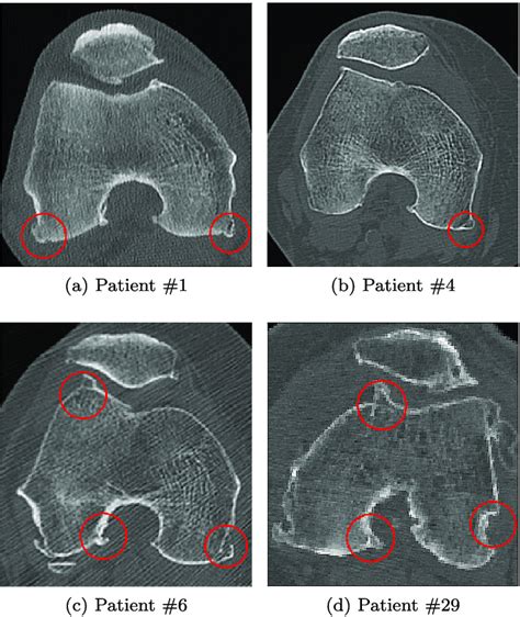 Axial Slices Taken From 4 Patients Imaging The Distal Femur