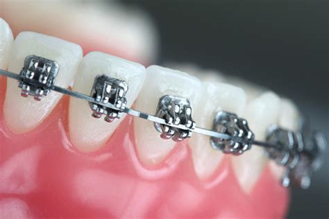 Xceed Orthodontics Course At Best Price In Nagpur Id 9258904433