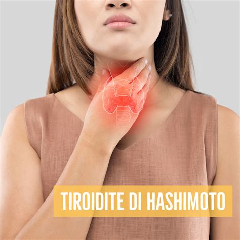 Cosè La Tiroidite Di Hashimoto E Cosa Mangiare Dott Nicola Savarese