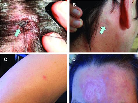Clinical Presentation Of The Patient With Senlat Scalp Eschar And Neck