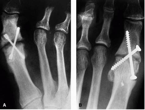Arthrodesis Of The First Metatarsophalangeal Joint Musculoskeletal Key