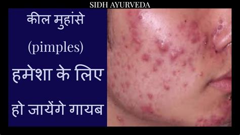 Ayurvedic Method To Remove Pimples Acneblack Heads कीलमुहांसो का