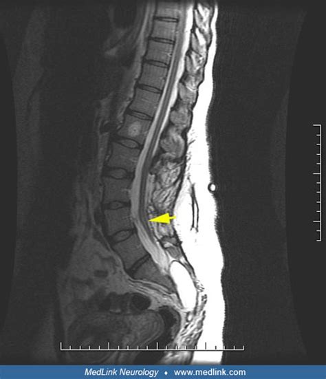 Tethered Spinal Cord Medlink Neurology