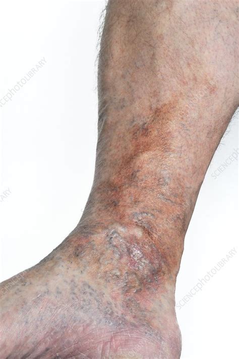Varicose Eczema On The Leg Stock Image C0103352 Science Photo