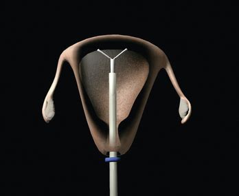 Intrauterine Device IUD Insertion Basicmedical Key