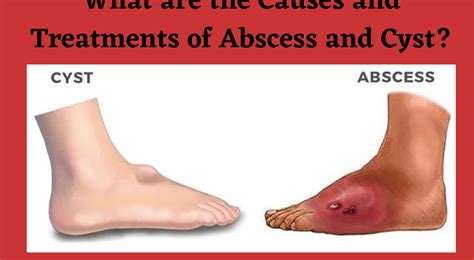 What Are The Causes And Treatments Of Abscesses And Cysts Happiness