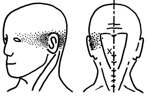 Suboccipital Muscles Trigger Points