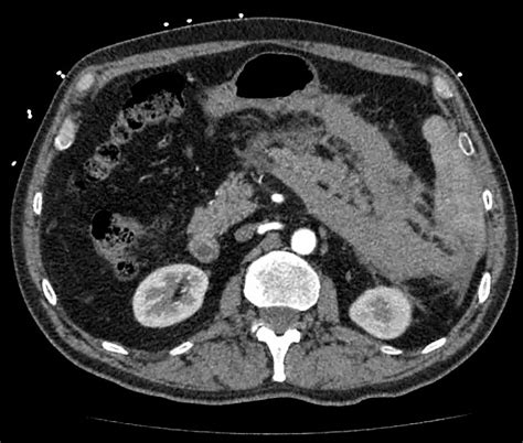 Splenic Artery Pseudoaneurysm Rupture Consultant360