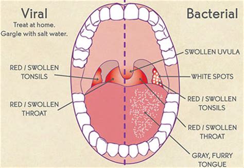 The most common symptoms are persistent hoarseness, a sore throat lasting longer than four to six weeks, and trouble swallowing. Sore Throat: Top Causes, Symptoms and Treatment Options