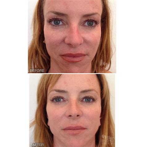 Medical Spa West La And La Cañada Flintridge Skin Specifics Full Face Rejuvenation 8298
